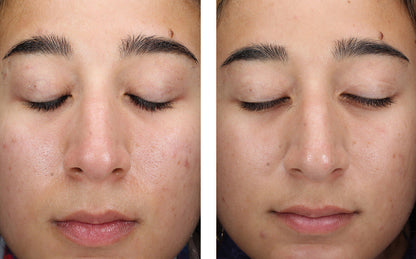 AlphaRet Clearing Serum