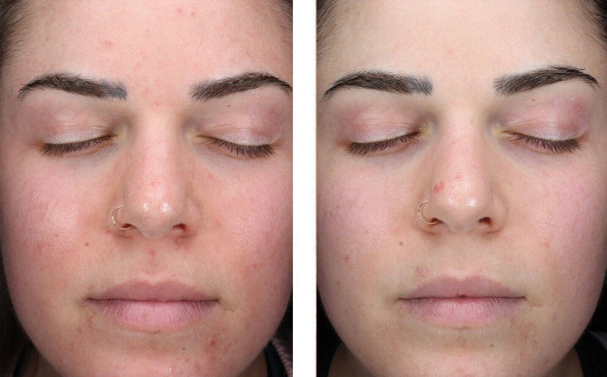 AlphaRet Clearing Serum