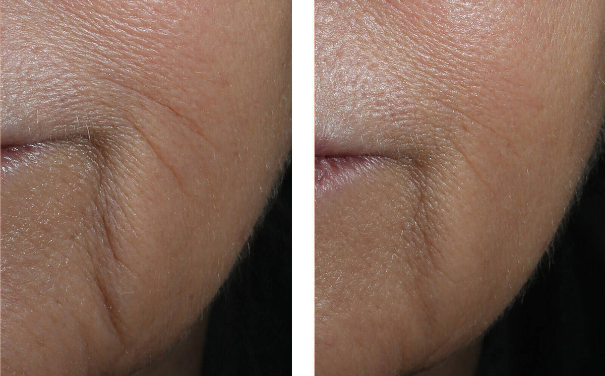 InterFuse Intensive Treatment LINES