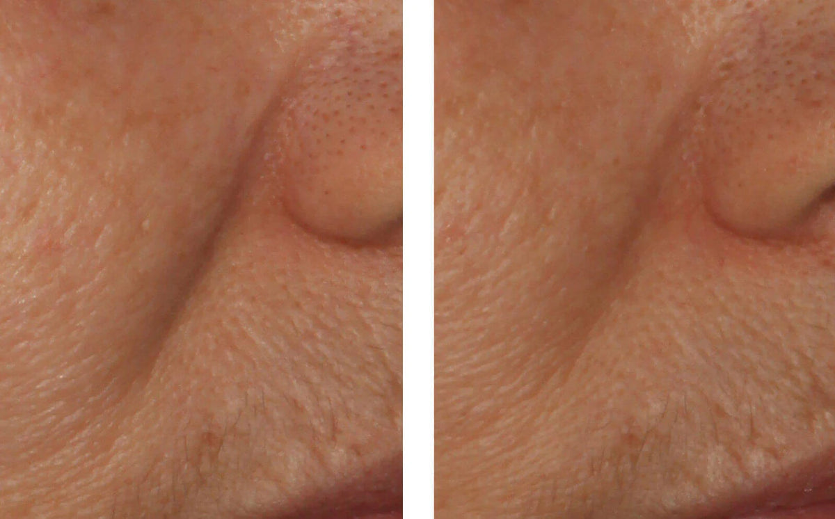 InterFuse Intensive Treatment LINES