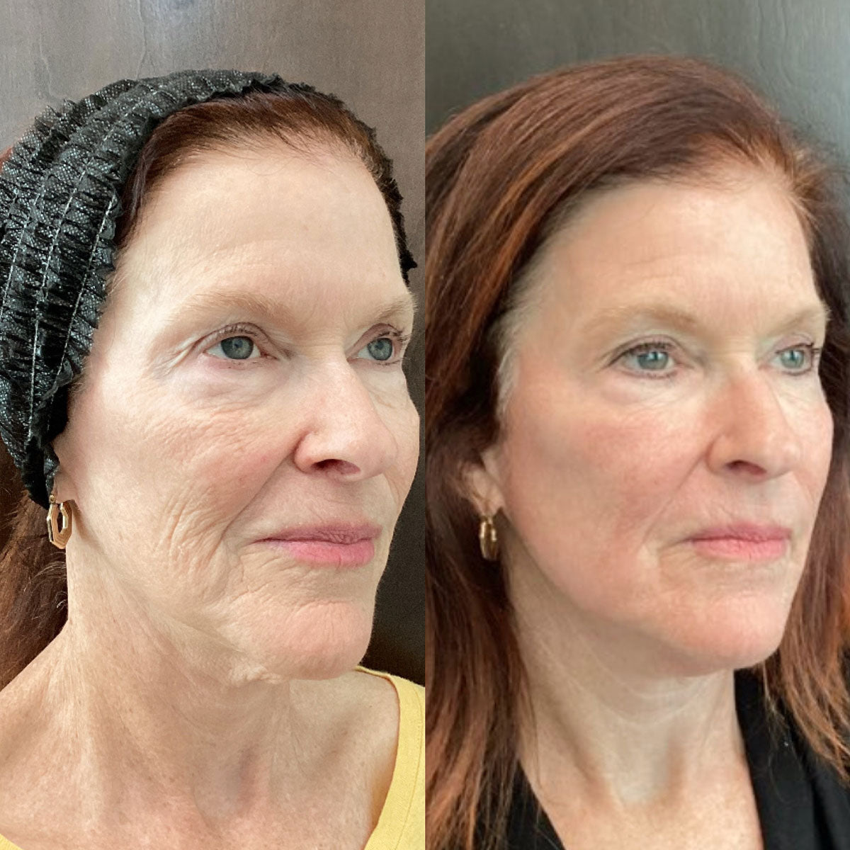 Before and after comparison of a woman's face with visible aging changes.